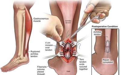 Achilles Tendon Repair Surgery in NYC