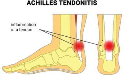 Achilles Tendon Surgery in New Jersey