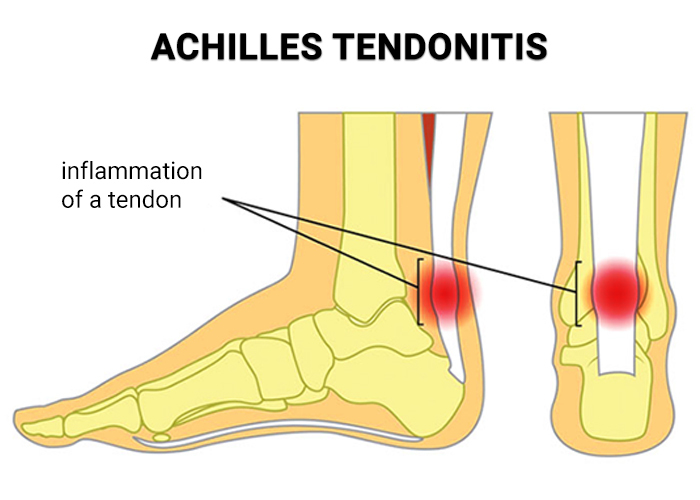 Achilles Tendon Surgery in New Jersey