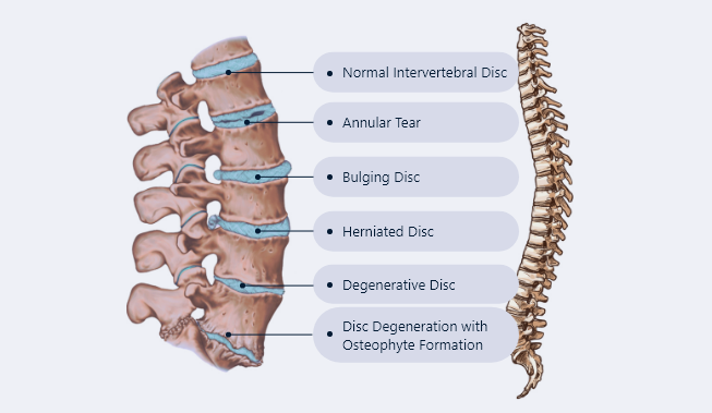 NYC Back Pain Treatment | New York Back Pain Specialists