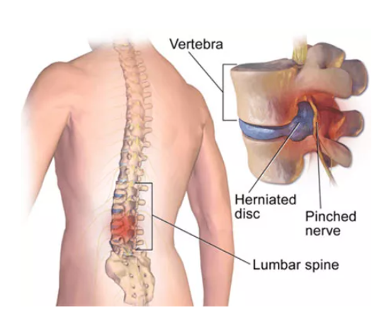 NJ Back Pain Treatment