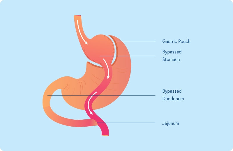 Bariatric Surgery | Weight Loss Surgery in New Jersey