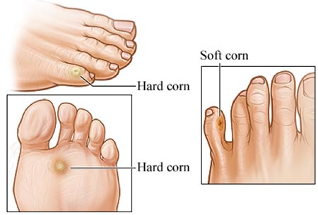 Corn Removal Surgery in New York