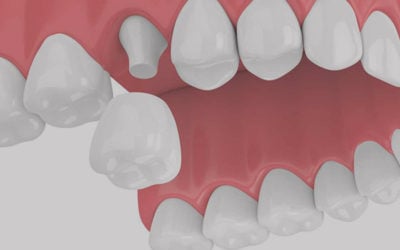 Dental Crowns in Stamford, CT