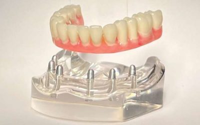 Full Mouth Dental Implants in Brooklyn, NY