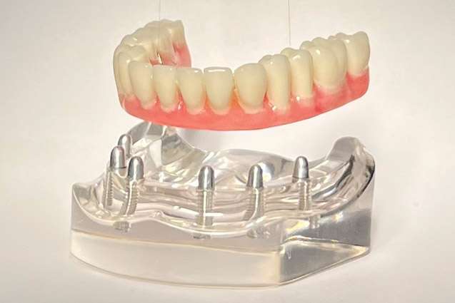 Full Mouth Dental Implants in Brooklyn, NY