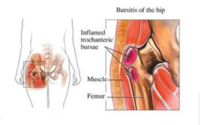 Hip Pain Treatment