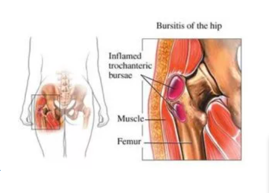 Hip Pain Treatment