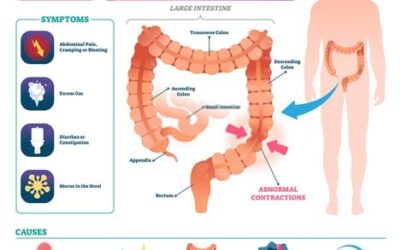 Top Irritable Bowel Syndrome Treatment Specialist