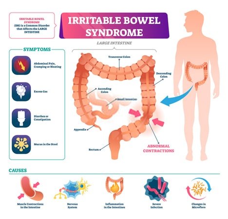 Top Irritable Bowel Syndrome Treatment Specialist