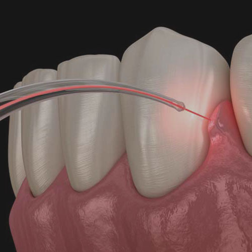 Laser Gum Surgery & Gum Recession Surgery in Brooklyn NY
