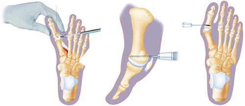 Minimally Invasive Foot Surgery in New York