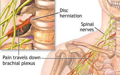 Neck Pain Treatment Specialists Doctors NYC