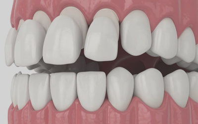 Dental Veneers Stamford, CT