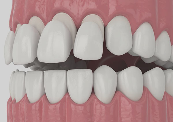 Dental Veneers Stamford, CT