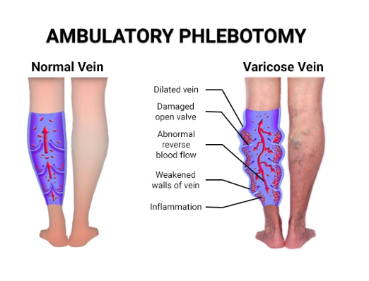 Ambulatory Phlebotomy in Brooklyn