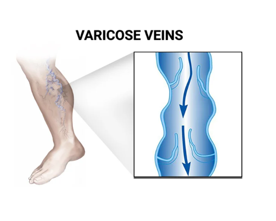 Varicose Veins Removal Doctor in Brooklyn, NY