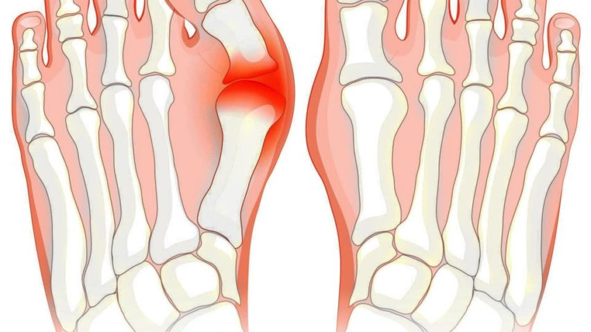 Bunion Surgery in New Jersey