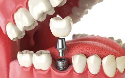 DENTAL IMPLANTS IN ASTORIA AND BAYSIDE, QUEENS