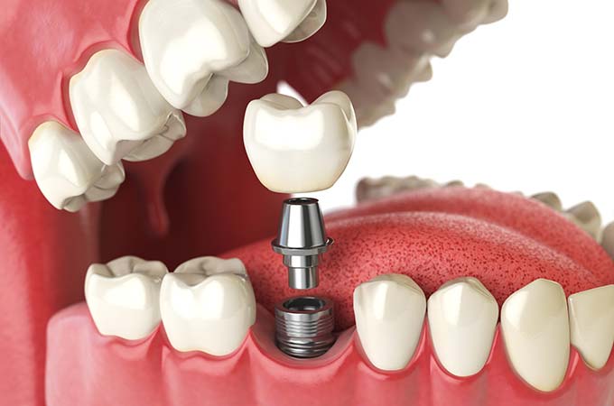 DENTAL IMPLANTS IN ASTORIA AND BAYSIDE, QUEENS