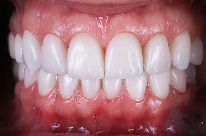 Cosmetic Dentistry in Astoria and Bayside, Queens