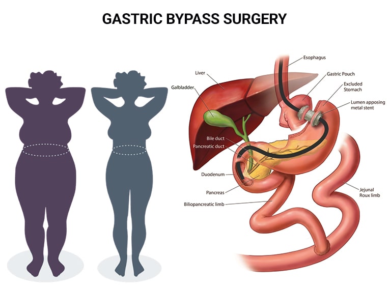 Gastric Bypass Surgery in New Jersey | Top Weight Loss Surgeons‎