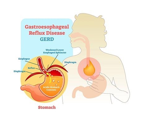 Best GERD Specialists in Upper East Side, NYC