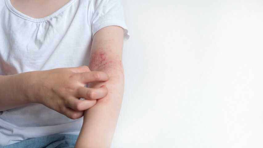 Skin Conditions That Might Be Linked to Allergies