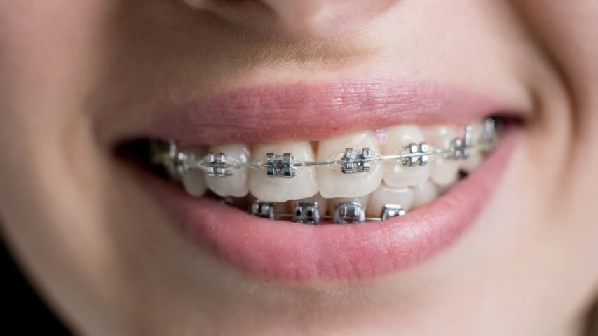 5 Signs You Might Need Braces or Aligners