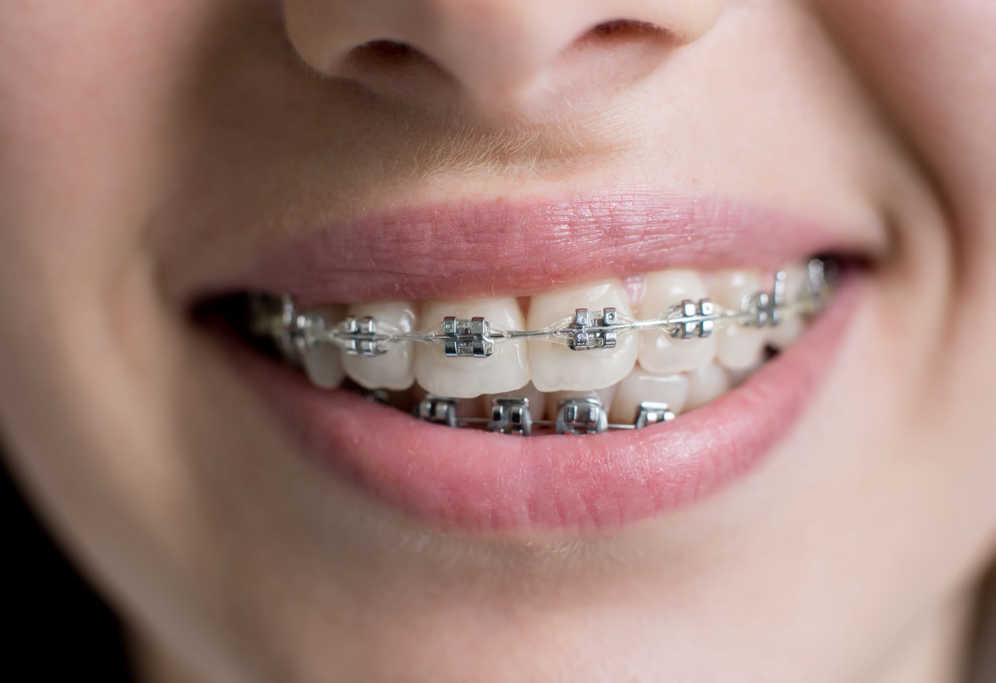 5 Signs You Might Need Braces or Aligners