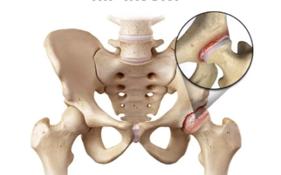 Hip Pain Treatment in NYCWhether you got a torn