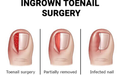 Ingrown Toenail TreatmentsAn ingrown toenail causes throbbing toe pain