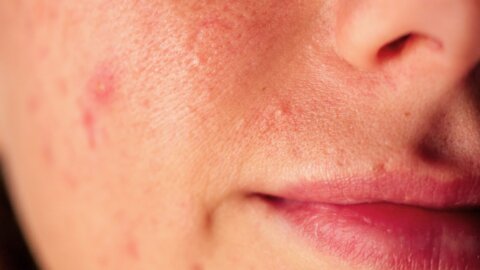 What is Rosacea?