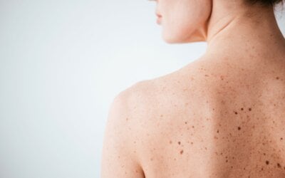 Skin Cancer Awareness: How to Check Your Skin at Home