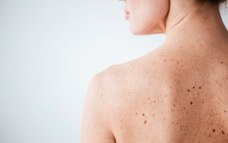 Skin Cancer Awareness: How to Check Your Skin at Home