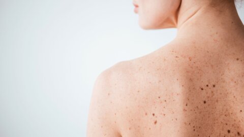 Skin Cancer Awareness: How to Check Your Skin at Home