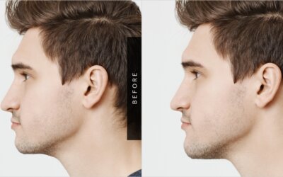 Chin AugmentationYour chin plays such an important role in