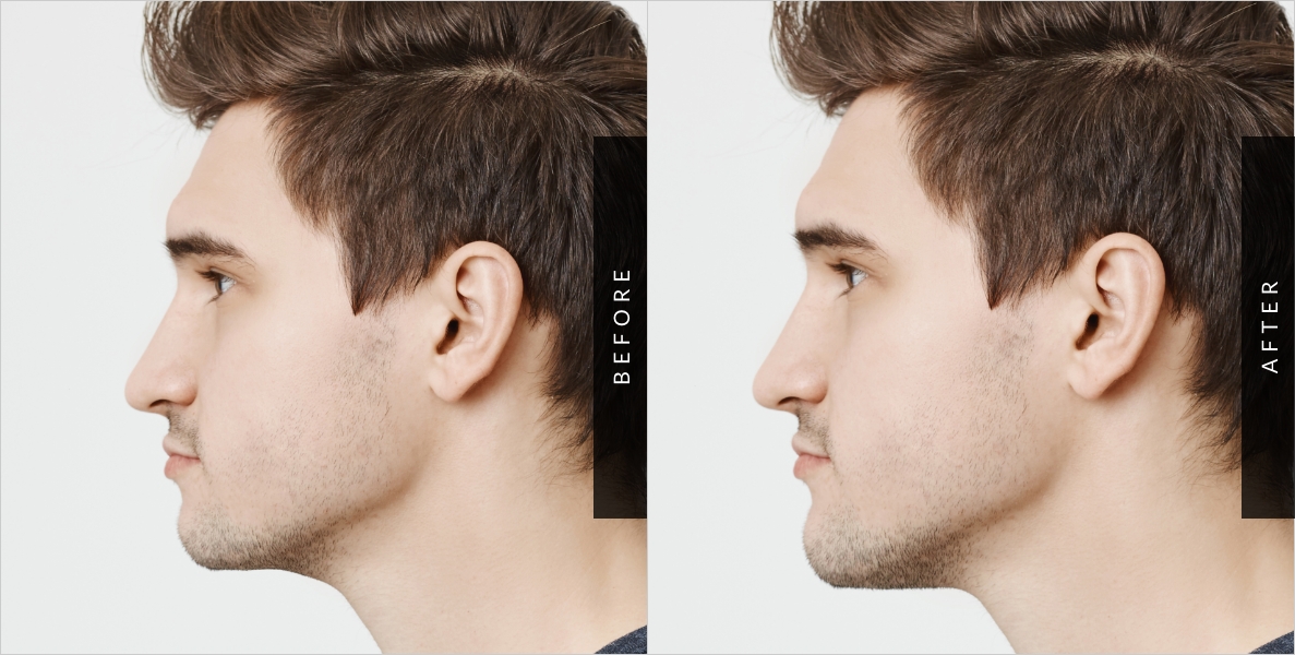 Chin AugmentationYour chin plays such an important role in