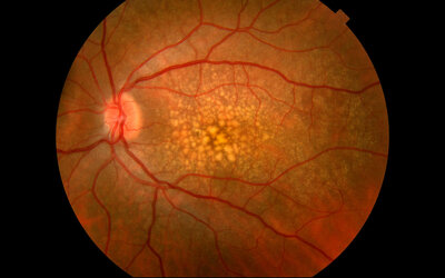 Age-Related Macular DegenerationMany people with macular degeneration experience