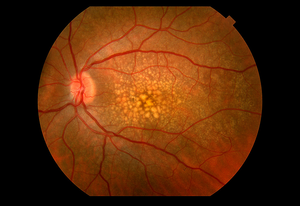 Age-Related Macular DegenerationMany people with macular degeneration experience