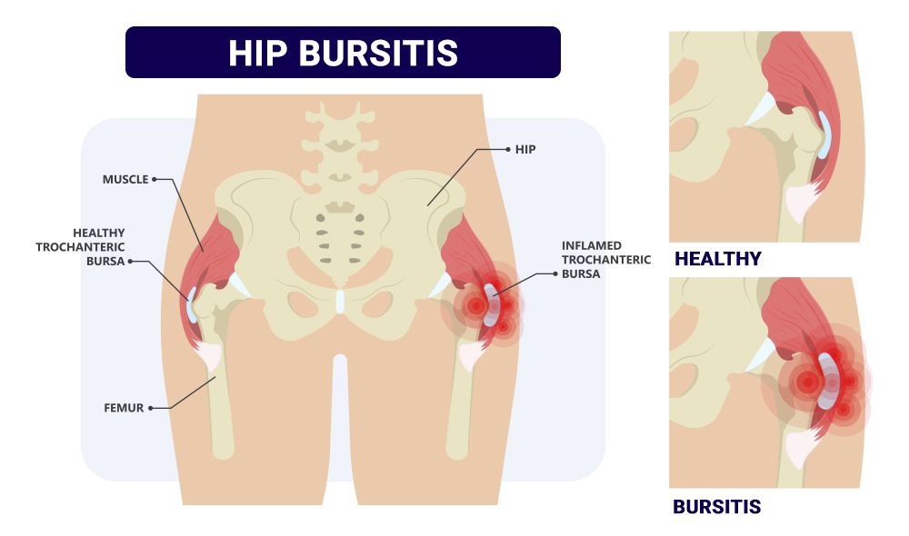 Physical Therapy for Hip Pain in New York, NY: