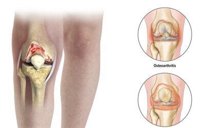 Arthritis Physical Therapy in New York, NYArthritis is the