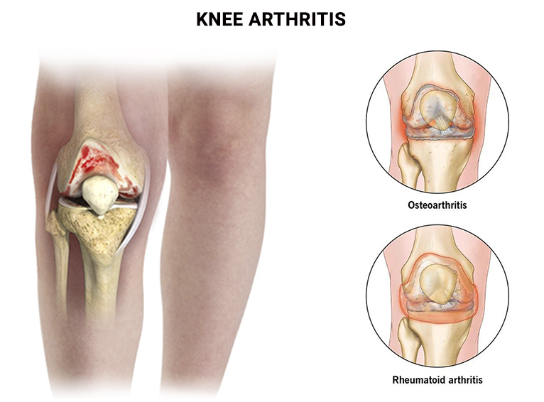 Arthritis Physical Therapy in New York, NYArthritis is the