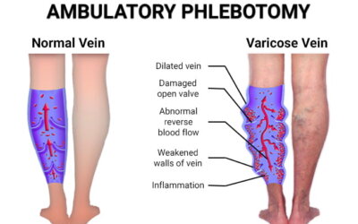 Varicose veins affect different people in different ways. Some