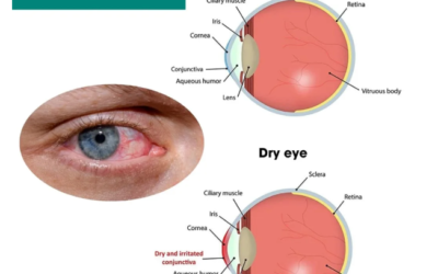 Dry Eye TreatmentDry eyes can be uncomfortable, as they