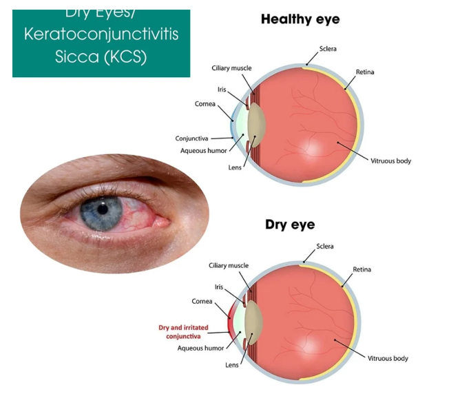 Dry Eye TreatmentDry eyes can be uncomfortable, as they