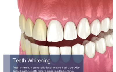 Teeth Whitening in NYCHow Does Teeth Whitening Work?Teeth