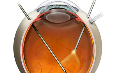 Vitrectomy Surgery SpecialistVitrectomy is a microsurgical procedure used to