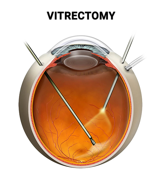 Vitrectomy Surgery SpecialistVitrectomy is a microsurgical procedure used to