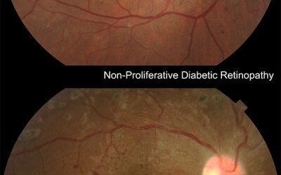 Diabetic RetinopathyPeople with diabetes are unfortunately at a higher